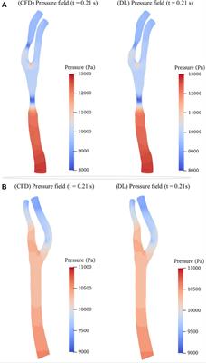 Deep learning-based hemodynamic prediction of carotid artery stenosis before and after surgical treatments